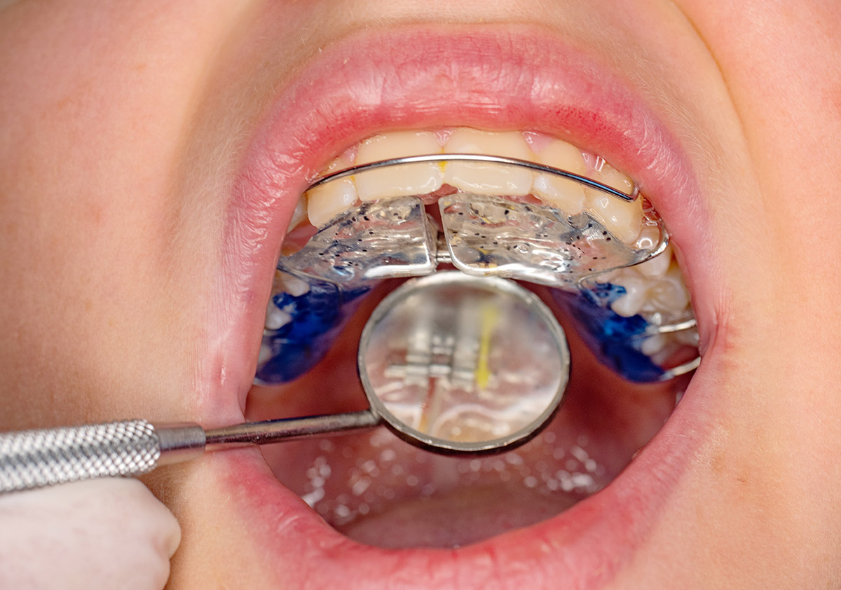 metal braces teeth alignment
