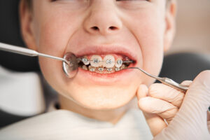 metal braces teeth alignment